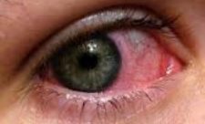 Conjunctivitis outbreak Costa Rica