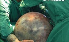 Costa Rica Massive Tumor Removed