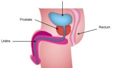 Costa Rica Prostate Cancer